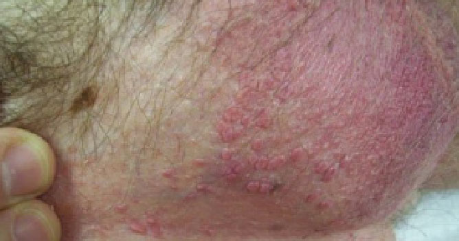 Human papillomavirus rash description, Hpv symptoms skin rash - tulipanpanzio.ro